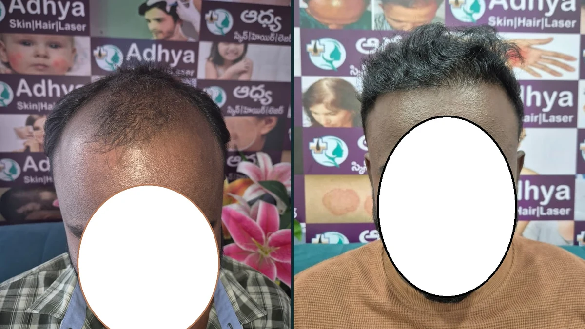 FUE Hair Transplant Before & After Result Adhya Hospital