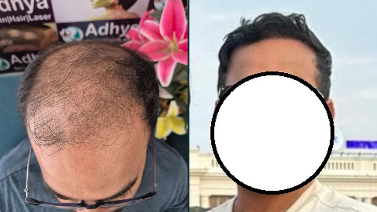 Scalp Hair Loss GFC Before & After Result Adhya Hospital