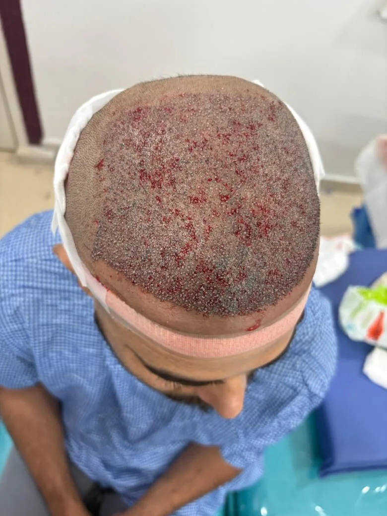 Hair Transplant Operation Suite Adhya Hospital