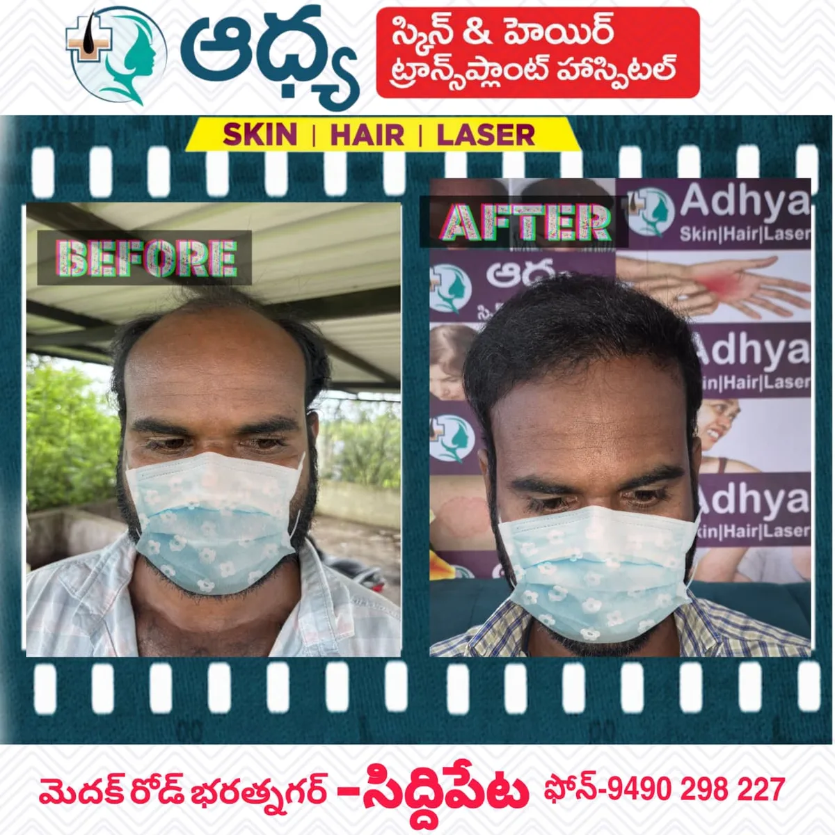 FUE Hair Transplant Patient Result Adhya Hospital Siddipet