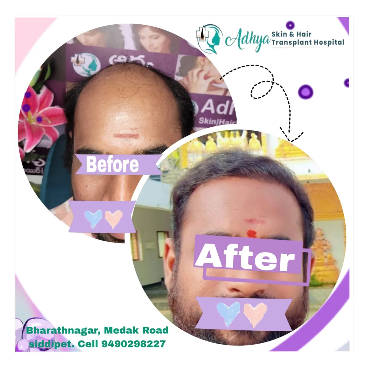 GFC Bio-PRP Hair Regrowth Result