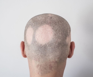 best treatment for Alopecia Areata in Siddipet