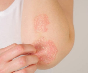 best treatment for Eczema in Siddipet