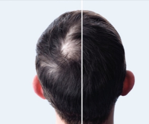 best treatment for GFC for Hair loss in Siddipet