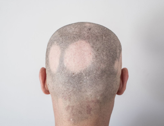 Best Alopecia Areata treatment near siddipet