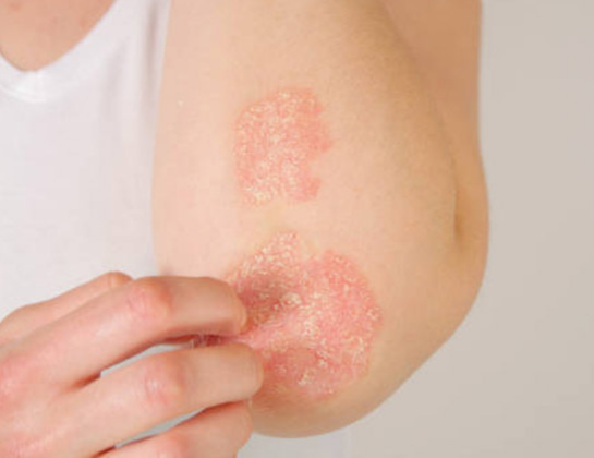 Best eczema treatment near siddipet