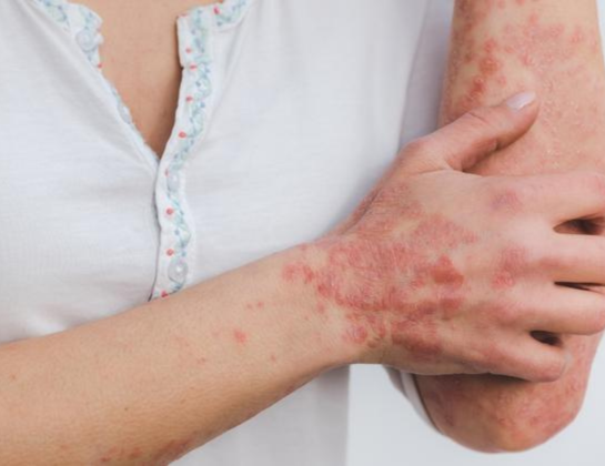 Best psoriasis treatment near siddipet