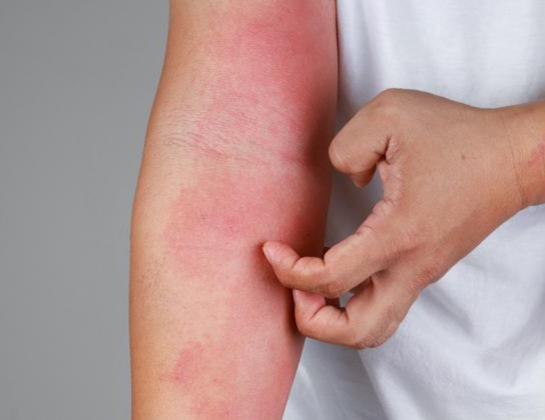 Best skin allergies treatment near siddipet