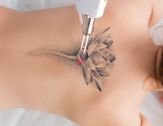 Best Laser tattoo removal treatment near siddipet