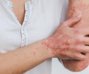 best treatment for Psoriasis in Siddipet