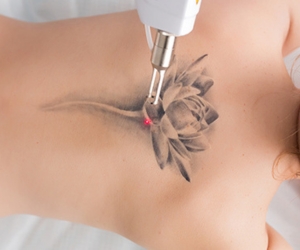 best treatment for Tattoo Removal in Siddipet